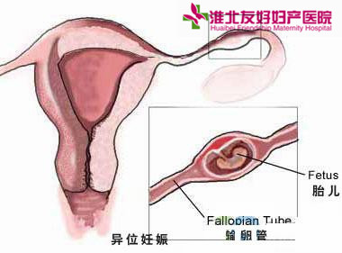 宮外孕最佳治療時(shí)期是什么時(shí)候