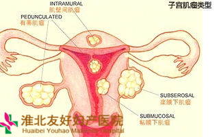 子宮肌瘤什么時(shí)候切