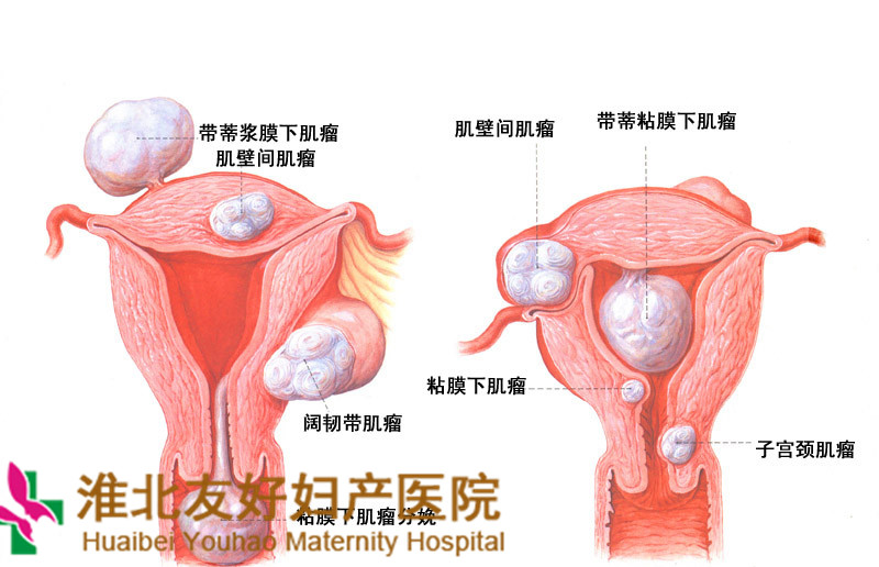 子宮肌瘤孕婦如何安度孕期