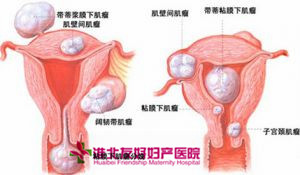 淮北治療子宮肌瘤價(jià)格