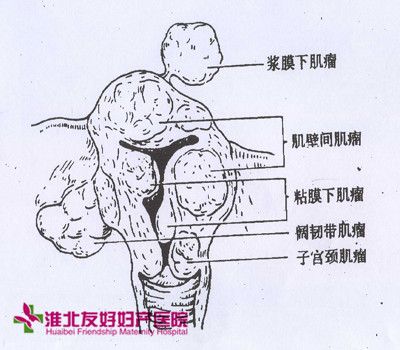 怎么檢查有無子宮肌瘤