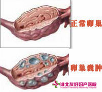 卵巢囊腫的癥狀有哪些